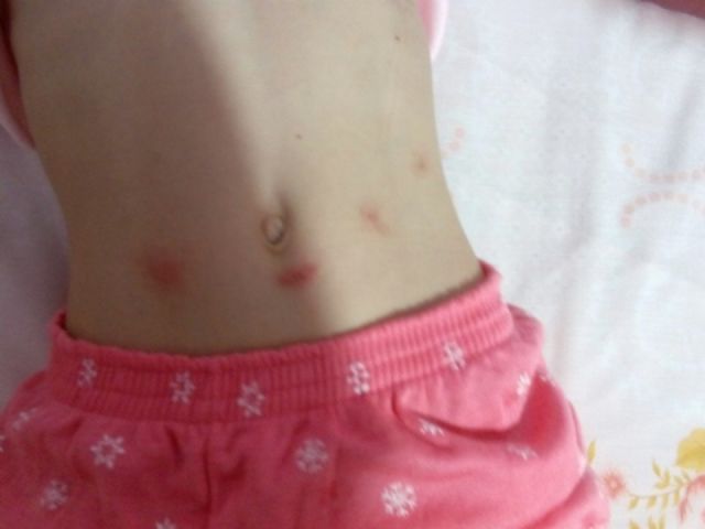 El PSOE exige que se actúe de inmediato contra una plaga de pulgas en el CEIP Villaespesa de Tercia